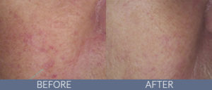 Laser and Light Treatments Gallery