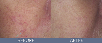 Clarity™ Advanced Multi-purpose Laser Before and After, DeSoto, TX