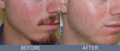 Clarity™ Advanced Multi-purpose Laser Before and After, DeSoto, TX