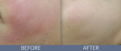 Clarity™ Advanced Multi-purpose Laser Before and After, DeSoto, TX