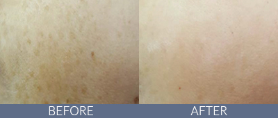 Clarity™ Advanced Multi-purpose Laser Before and After, DeSoto, TX