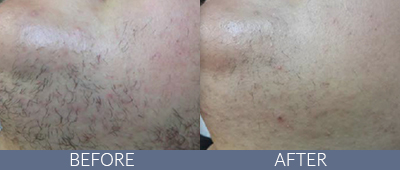 Clarity™ Advanced Multi-purpose Laser Before and After, DeSoto, TX