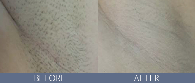 Clarity™ Advanced Multi-purpose Laser Before and After, DeSoto, TX