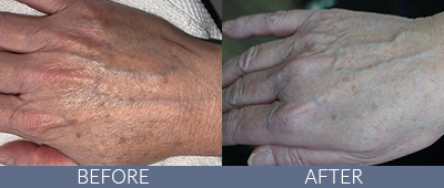 LaseMD Ultra™ Before and After, DeSoto, TX