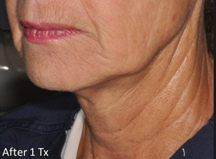 After Neck Microneedling