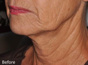 Before Neck Microneedling