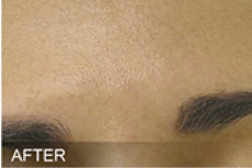 Hydrafacial After Ex1