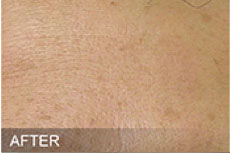 Hydrafacial After Ex3