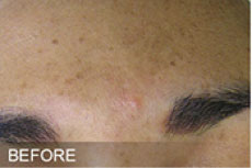 Hydrafacial Before Ex1