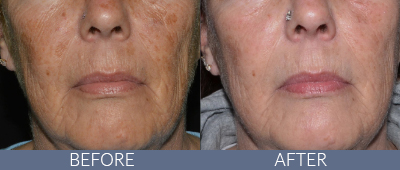 LaseMD Ultra™ Before and After, DeSoto, TX