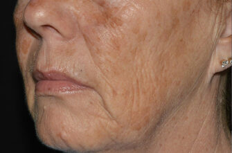LaseMD Ultra™ laser skin resurfacing Before