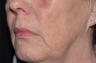LaseMD Ultra™ laser skin resurfacing After