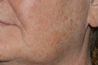 LaseMD Ultra™ laser skin resurfacing Before