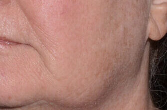 LaseMD Ultra™ laser skin resurfacing After