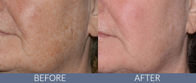 LaseMD Ultra™ Before and After, DeSoto, TX