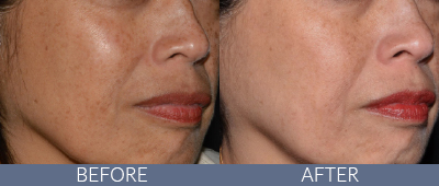 LaseMD Ultra™ Before and After, DeSoto, TX