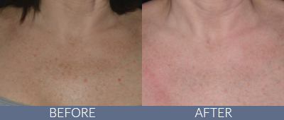 LaseMD Ultra™ Before and After, DeSoto, TX