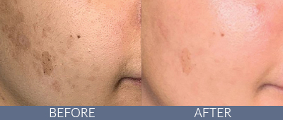 LaseMD Ultra™ Before and After, DeSoto, TX