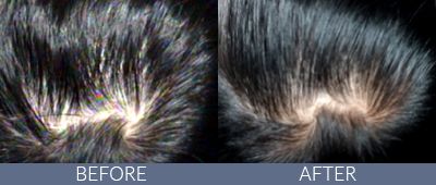 KeraLase™ Before and After, DeSoto, TX