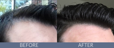KeraLase™ Before and After, DeSoto, TX