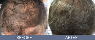 KeraLase™ Before and After, DeSoto, TX