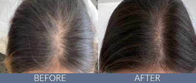 KeraLase™ Before and After, DeSoto, TX