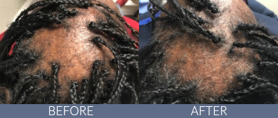 KeraLase™ Before and After, DeSoto, TX