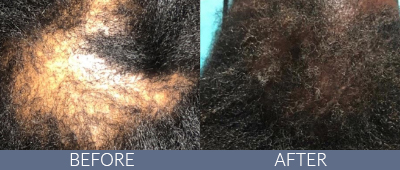 KeraLase™ Before and After, DeSoto, TX