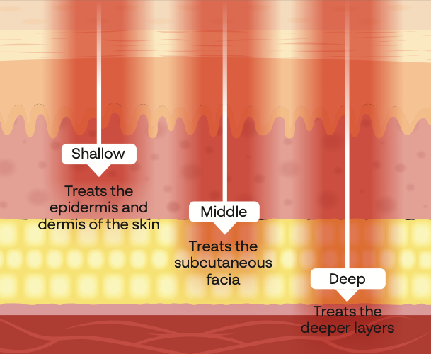 Multi-depth approach