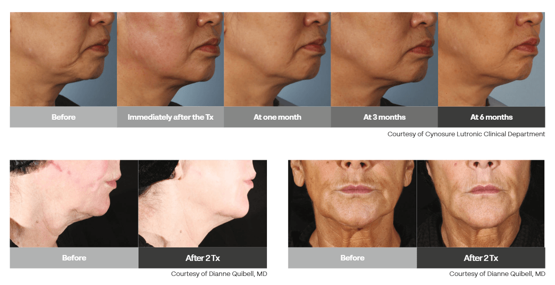 XERF Structural Skin Tightening Results