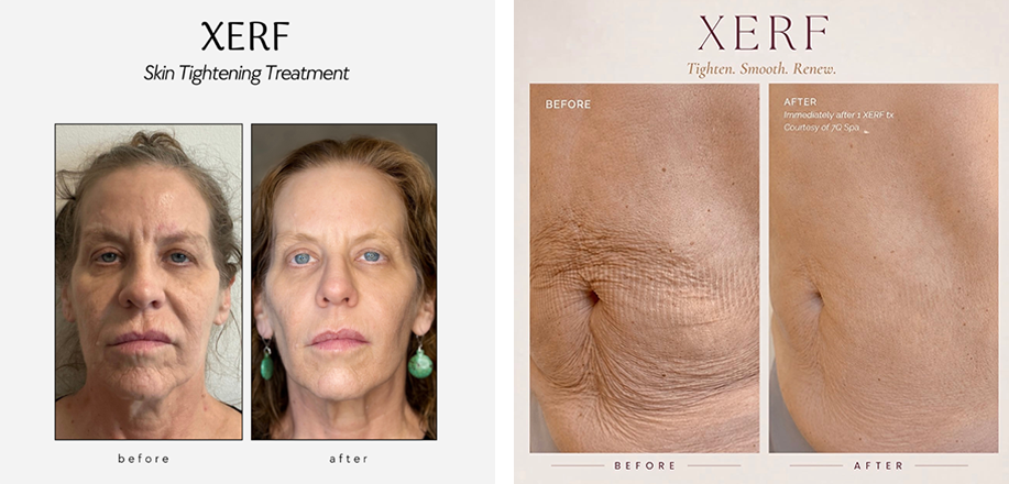 The Ultimate Reset XERF2