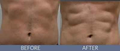 Body Sculpting Before and After, DeSoto, TX