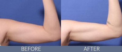 Body Sculpting Before and After, DeSoto, TX