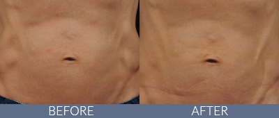Body Sculpting Before and After, DeSoto, TX