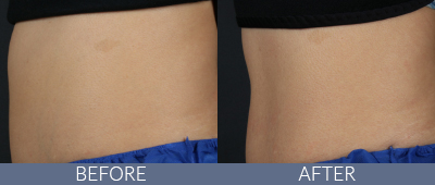 Body Sculpting Before and After, DeSoto, TX