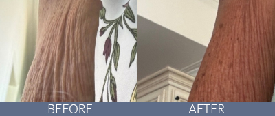 Body Sculpting Before and After, DeSoto, TX