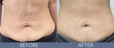 Body Sculpting Before and After, DeSoto, TX