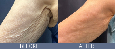 Body Sculpting Before and After, DeSoto, TX