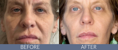 XERF™ structural skin tightening Before and After, DeSoto, TX