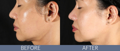XERF™ structural skin tightening Before and After, DeSoto, TX