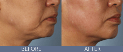 XERF™ structural skin tightening Before and After, DeSoto, TX