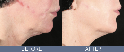 XERF™ structural skin tightening Before and After, DeSoto, TX