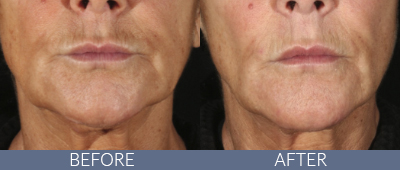 XERF™ structural skin tightening Before and After, DeSoto, TX