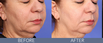XERF™ structural skin tightening Before and After, DeSoto, TX