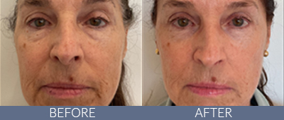 XERF™ structural skin tightening Before and After, DeSoto, TX