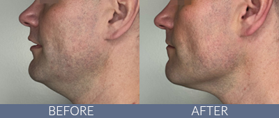 XERF™ structural skin tightening Before and After, DeSoto, TX