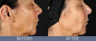 XERF™ structural skin tightening Before and After, DeSoto, TX