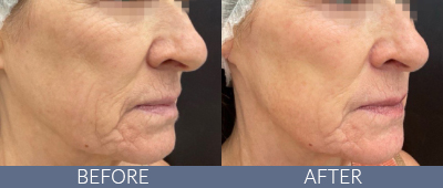 K-LUXE Skin Rejuvenation Before and After, DeSoto, TX