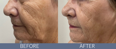 XERF™ structural skin tightening Before and After, DeSoto, TX