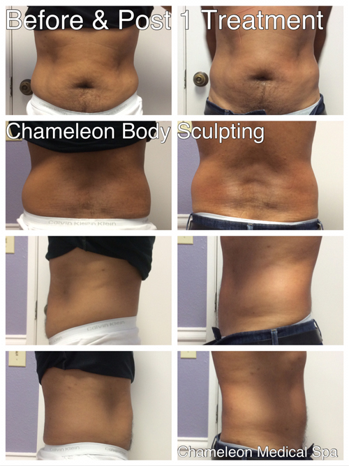 Before & After PelleFirm® RF Body Treatment